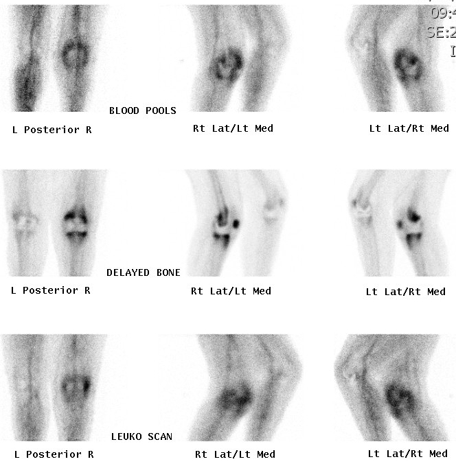 Bone Scan Infected TKR